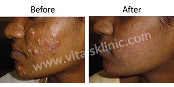 Treatment for acne (Before-After)