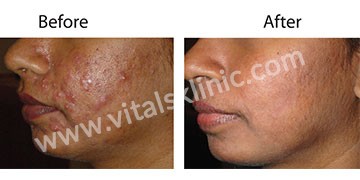 Acne Treatment in Bangalore (Before-After)