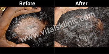 Best Hair Fall Treatment in Bangalore (2023)| VitalsKlinic