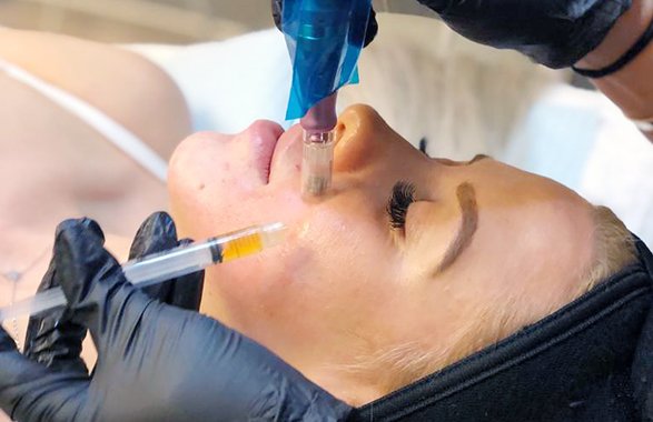 PRP and Micro Needling – Pre & Post Care Instructions