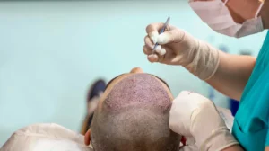 Hair-transplant-surgery