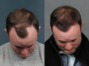 hair transplant