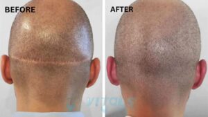FUT HAIR TRANSPLANT
