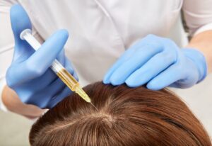 PRP HAIR LOSS