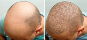 hair transplant