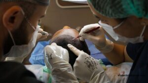 hair transplant