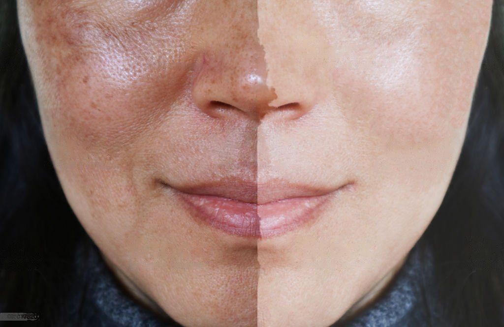 BEST TREATMENTS THAT TO CLOSE OPEN PORES ON FACE