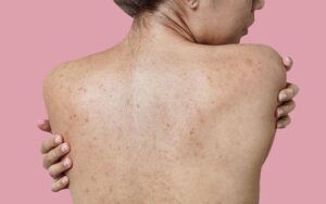 acne-on-back