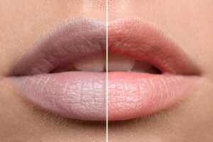 before after lip pigmentation