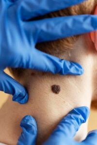 mole removal treatment in bangalore