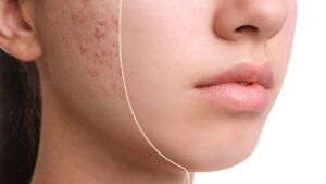 acne treatment