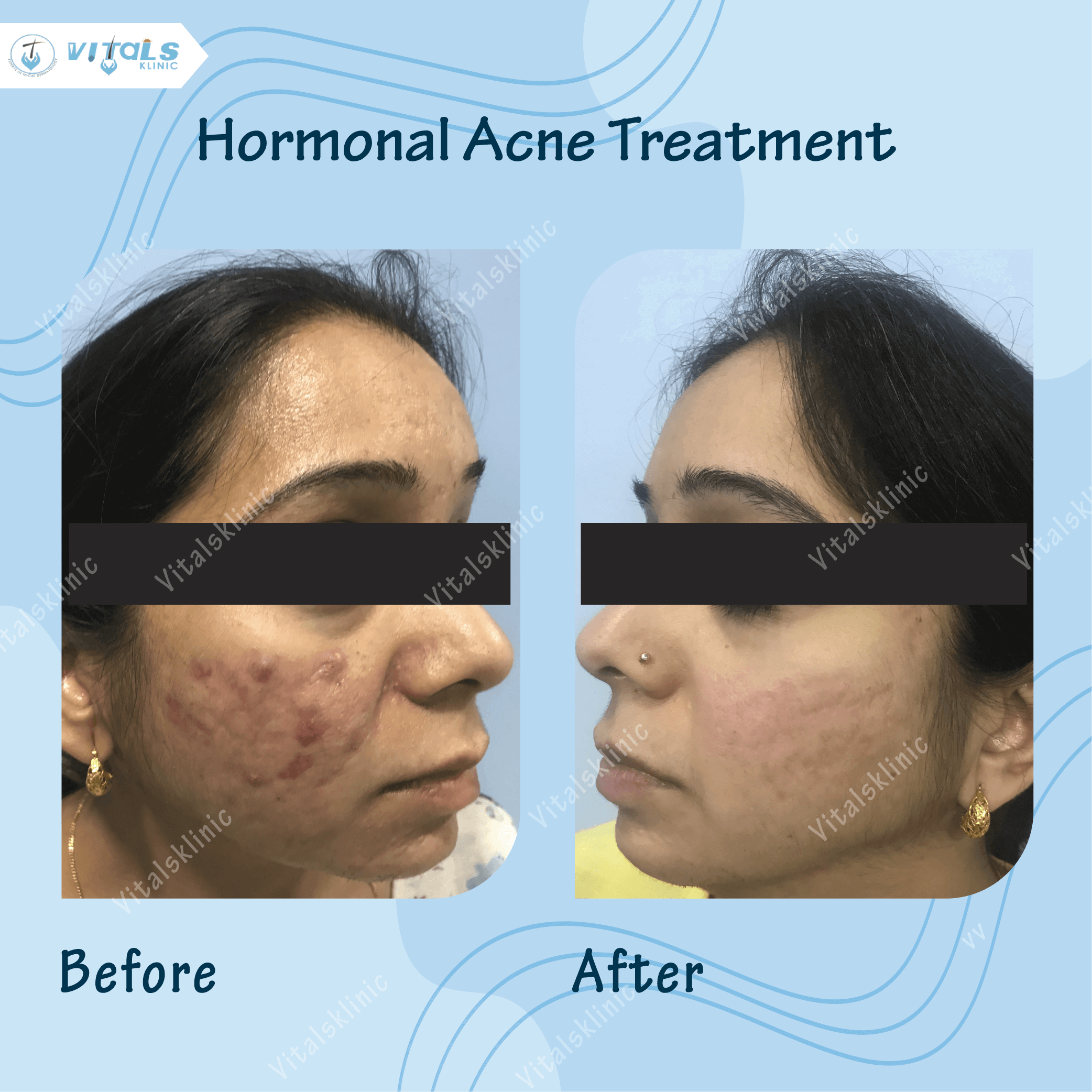 harmonal-acne-treatment
