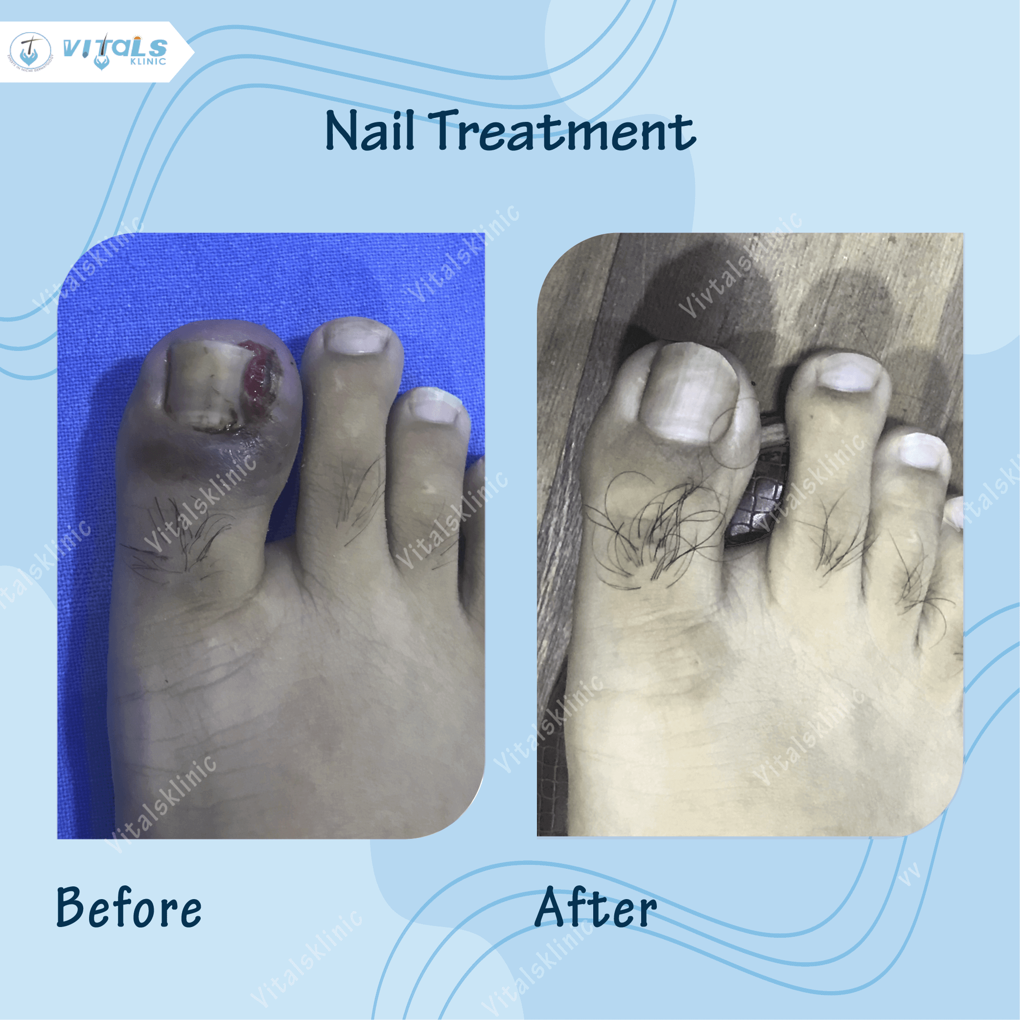 nail-treatment