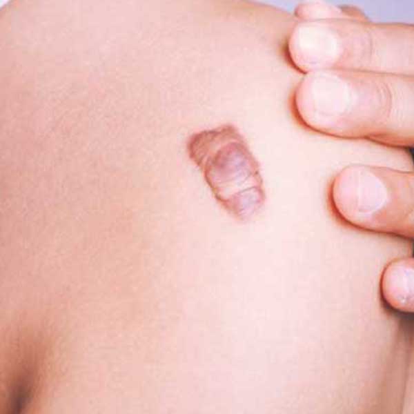 Keloid Scar Removal and Tretment in Bangalore 