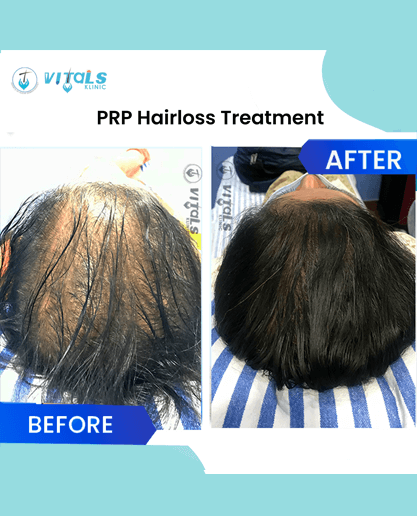 prp-hair-loss-treatment-1