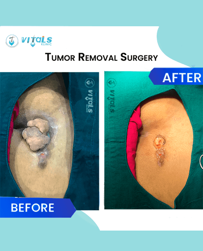 tumour-removal-surgery-1