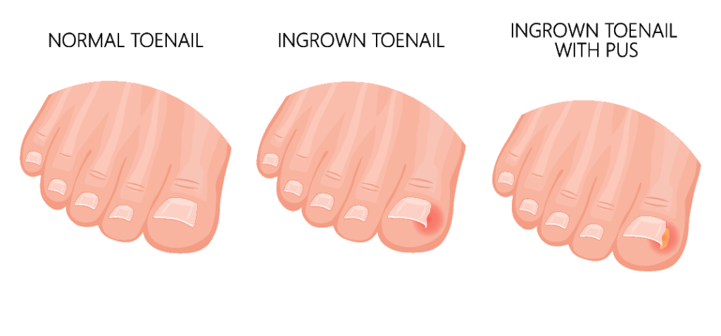 Best Ingrown Toe Nail Surgery in Bangalore [2023] | VitalsKlinic