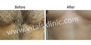 Laser-Hair-Removal-1