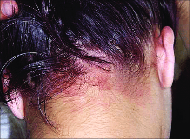 Simpler Hair Color Rash Hair Dye Allergy:Causes,Symptoms & Prevention | VitalsKlinic
