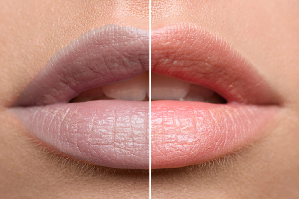 Best Lip Pigmentation Treatment, Bangalore Dr.HarishPrasad VitalsKlinic