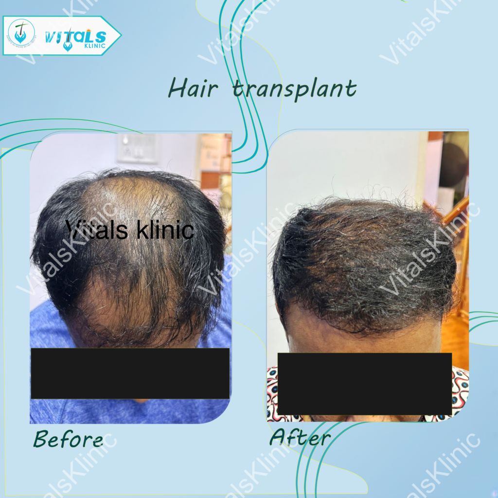 Hair Fall Treatment in Bangalore – 2025