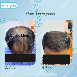 Top 10 Questions to Ask Before Getting a Hair Transplant
