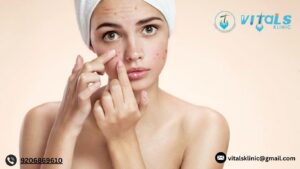 7 FACTORS OF A SUCCESS ACNE TREATMENT PLAN