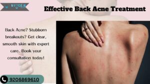 BACK ACNE: Causes, Remedies, Treatments & Results (2025)