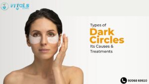 Dark Circles: Causes & Best Treatments in Bangalore