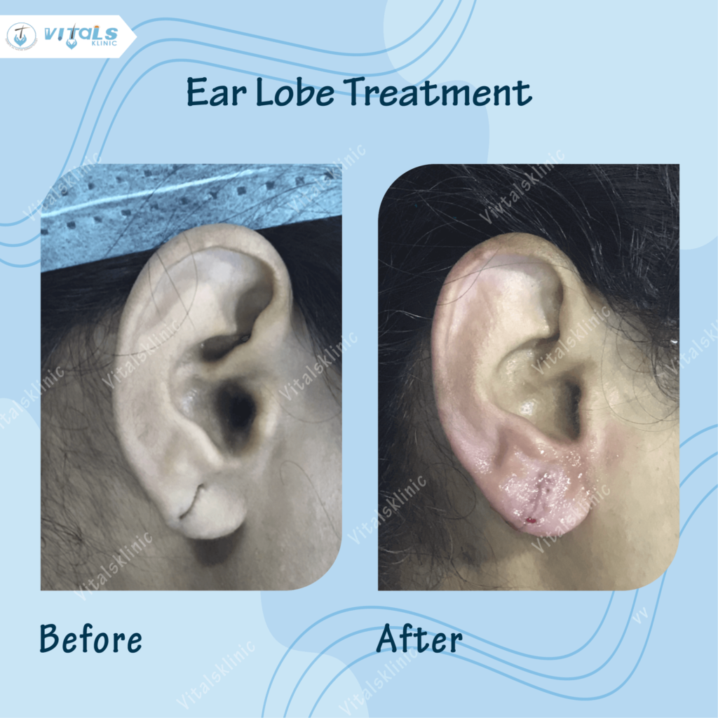 Earlobe Repair Surgery in Bangalore-2025