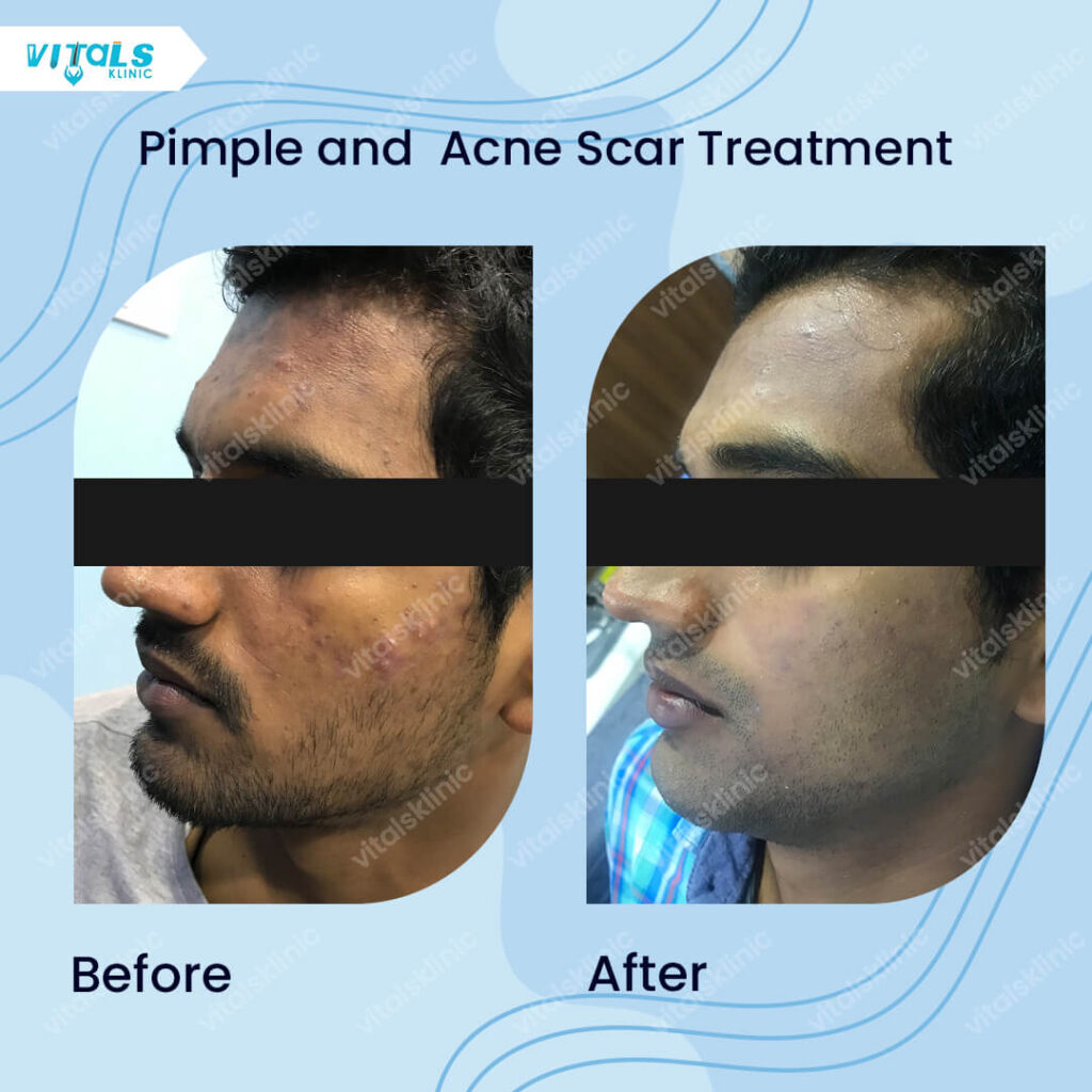 Scar Removal Treatment in Bangalore – 2025
