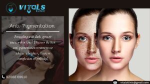 Best Anti-Pigmentation Treatments for Flawless Skin