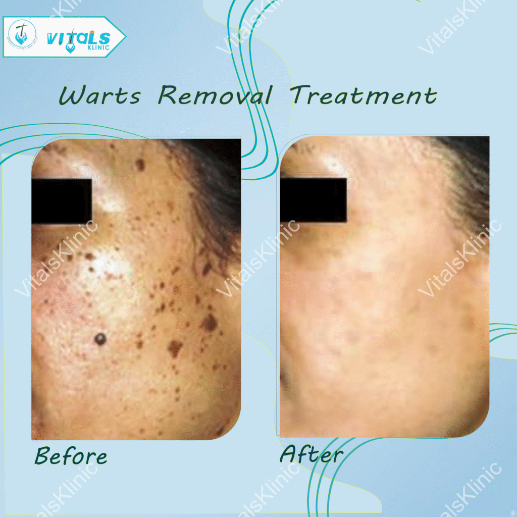 Wart Removal Treatment In Bangalore-2025
