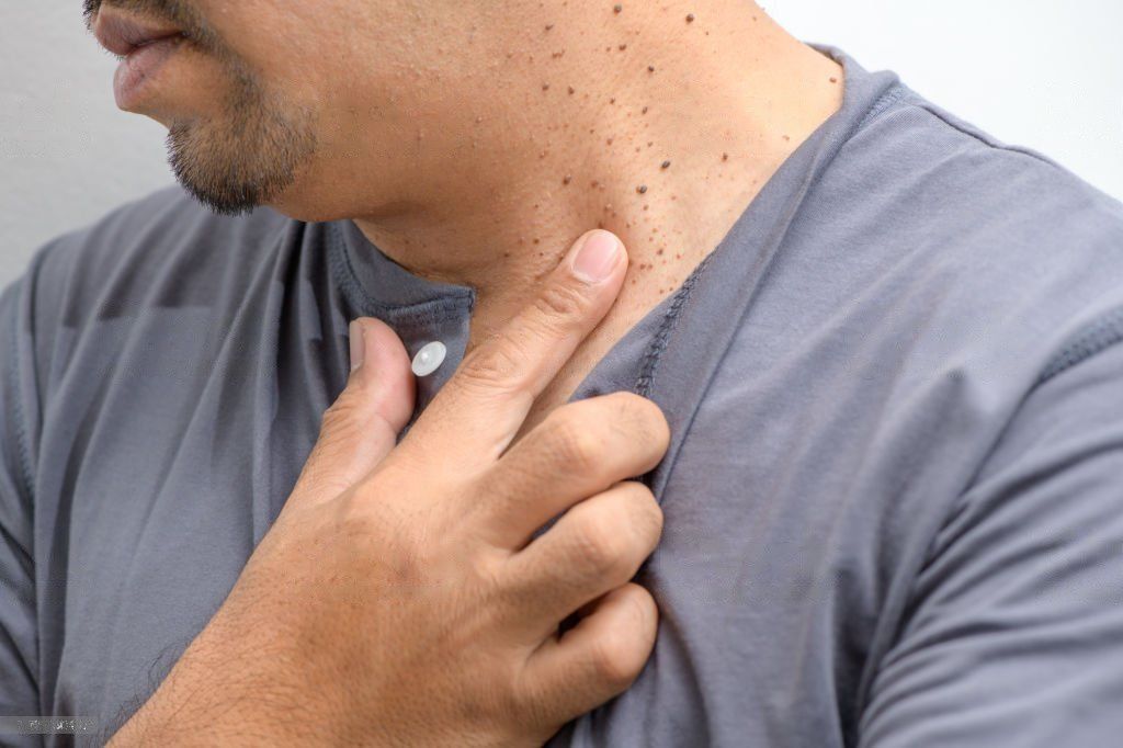SKIN TAG REMOVAL TREATMENT IN BANGALORE – 2025