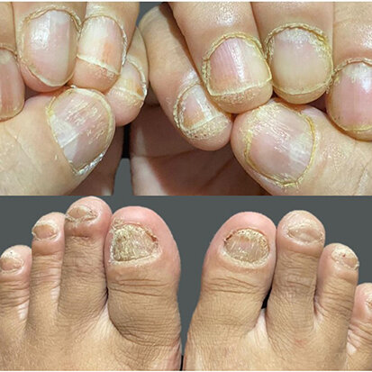 Nail Dystrophy Treatment in Bangalore-2025