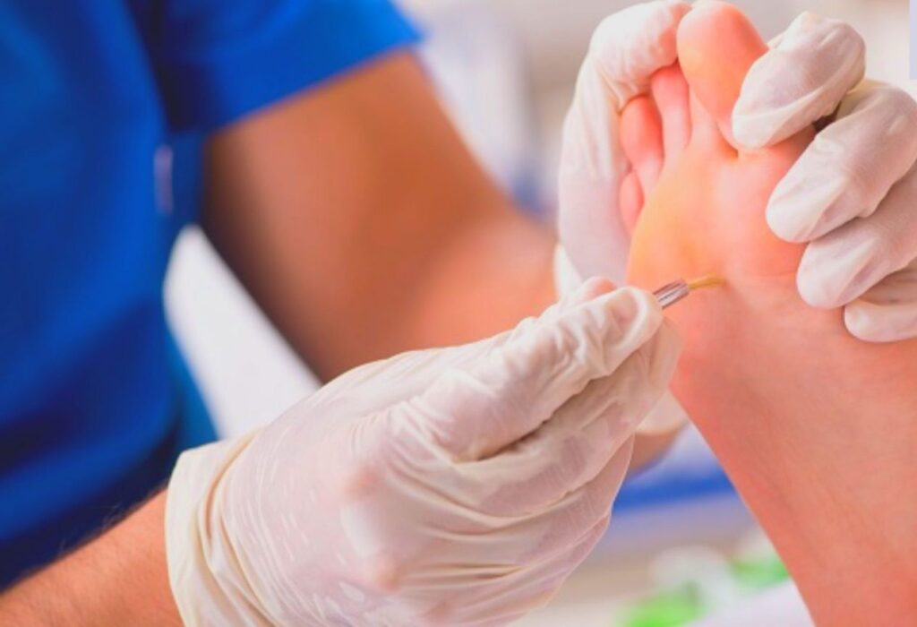 Corn Removal Surgery in Bangalore – 2025