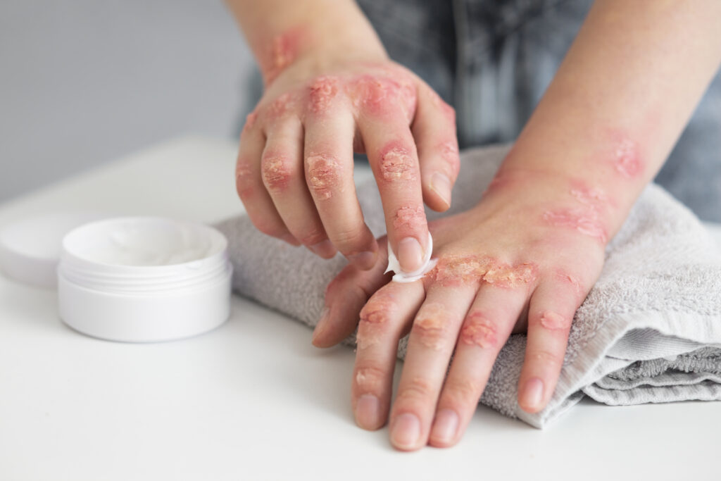 Eczema Treatment In Bangalore – 2025