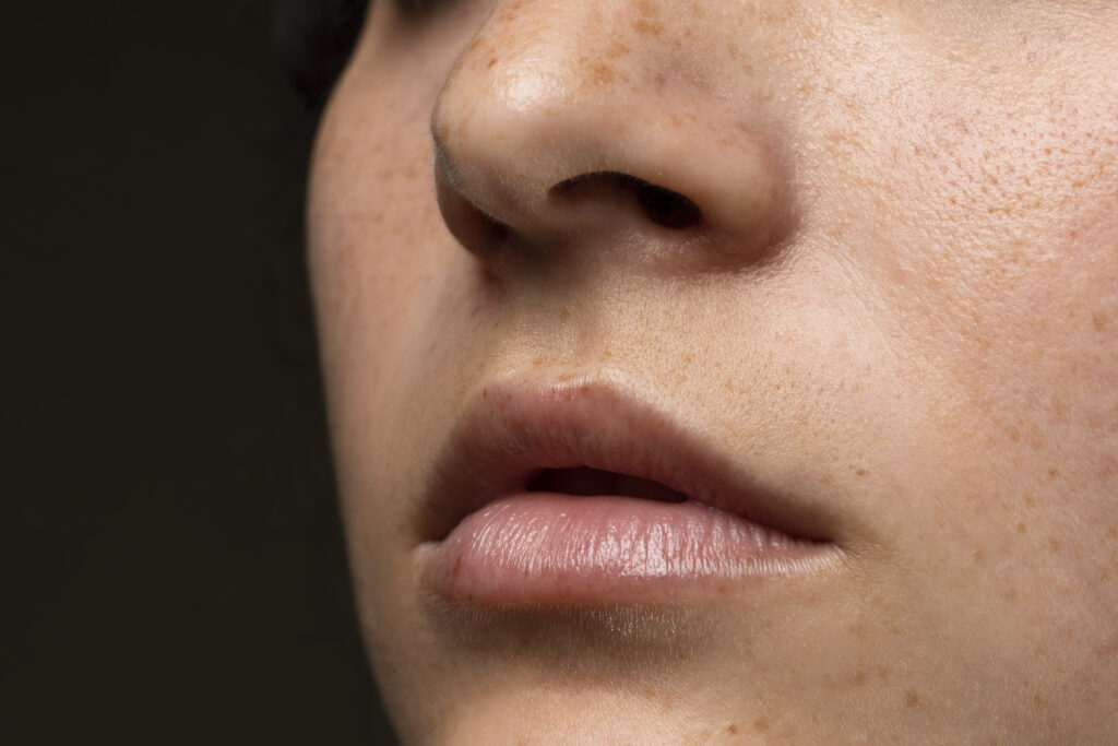 Open Pores Treatment in Bangalore –2025