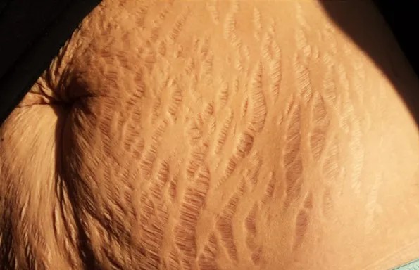 Stretch Mark Treatment in Bangalore-2025