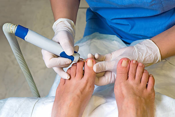 Ingrown Toe Nail Surgery in Bangalore – 2025