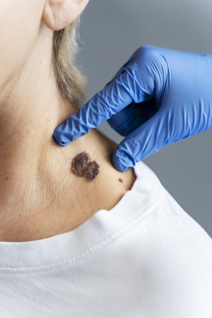 Mole Removal Treatment in Bangalore-2025