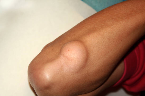 Best Lipoma Treatment In Bangalore – 2025