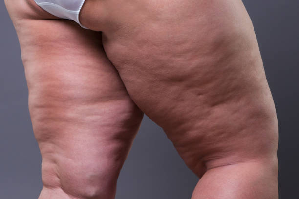 Cellulite Treatment in Bangalore – 2025