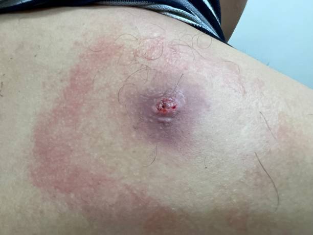 SEBACEOUS CYST REMOVAL TREATMENT IN BANGALORE – 2025