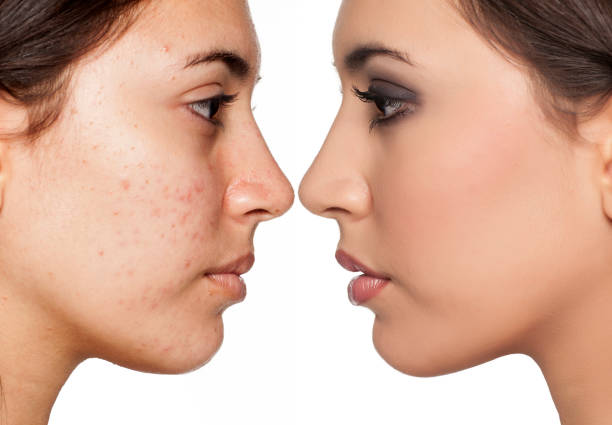 Spots Removal Treatment in Bangalore – 2025