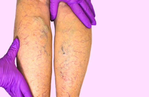 Varicose Veins Treatment in Bangalore-2025