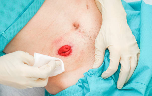 Cyst or Swelling Excision in Bangalore – 2025