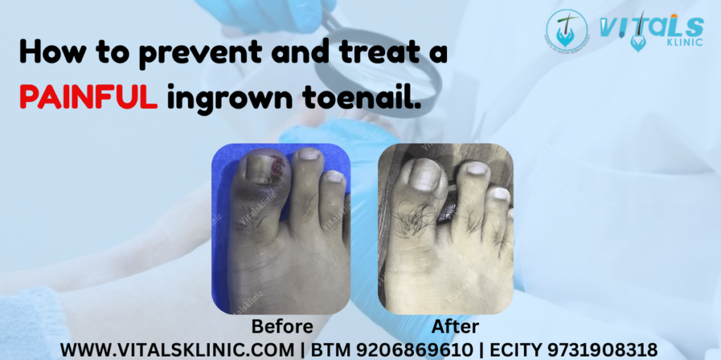 Ingrown Toe Nail Surgery in Bangalore – 2026
