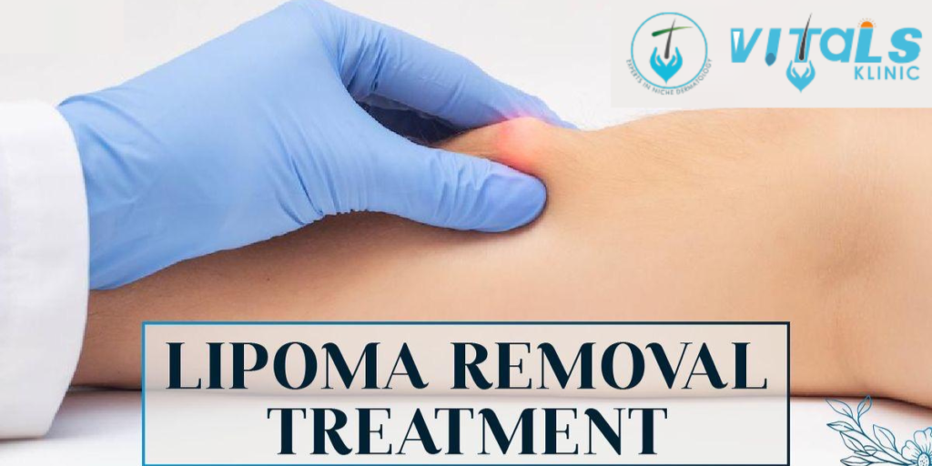 Best Lipoma Treatment In Bangalore
