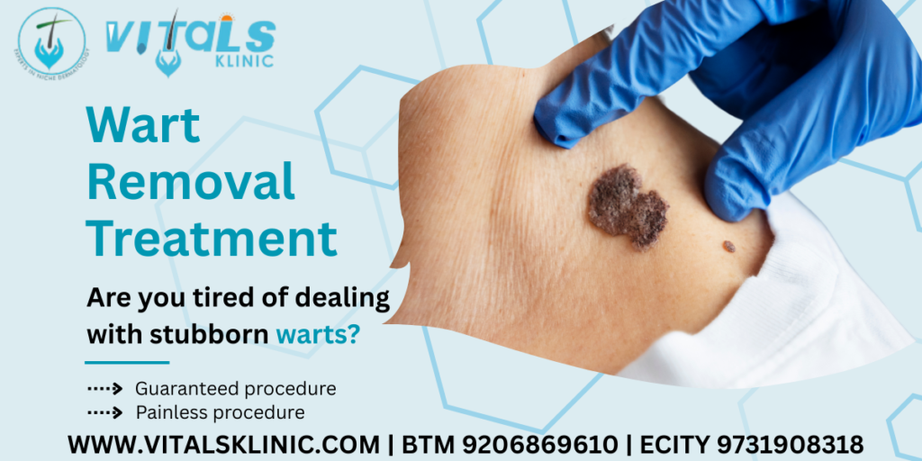 Wart Removal Treatment In Bangalore – 2026